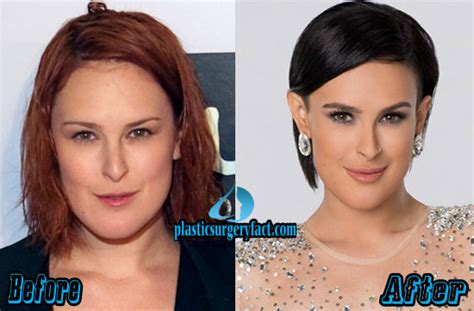 Rumer Willis Plastic Surgery Before and After Pictures