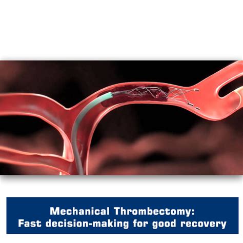 Advanced Mechanical Thrombectomy At Sushrut Brain And Spine