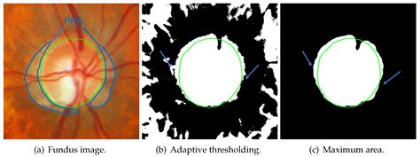 Multiple Preprocessing Hybrid Level Set Model For Optic Disc