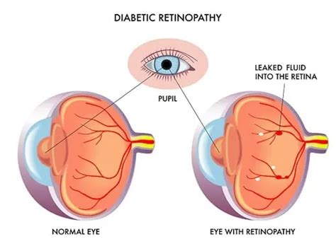 Diabetic Retinopathy Morristown Diabetes New Jersey