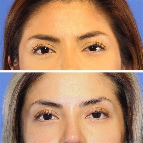 Eyelid Surgery Dr Jeffrey Lisiecki