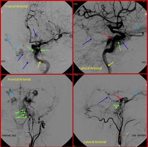 Brain Dural Fistula