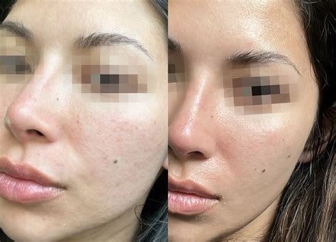 Rf Microneedling Potenza Level Laser Med Spa