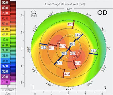 Millennialeye The Evolution Of Astigmatism Management