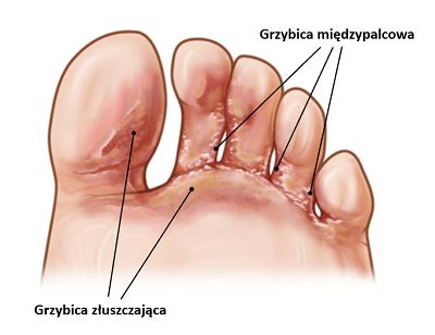 Grzybica Stopy Mi Dzy Palcami Jak Sobie Z Ni Radzi Vaya Medical