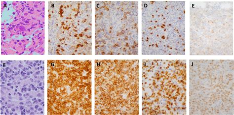 Anterior Cervical Lymph Nodes