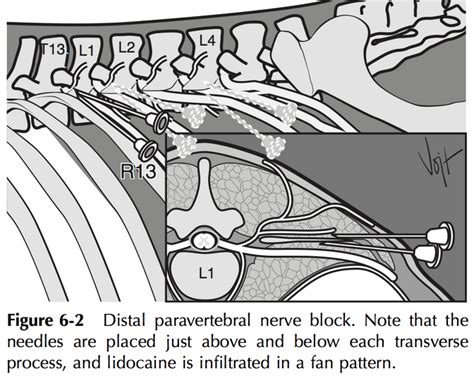 Distal Paravertebral Nerve Block