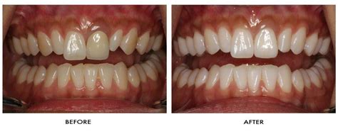 Patient Photos Dr Saurabhs Dental Clinic And Implant Center