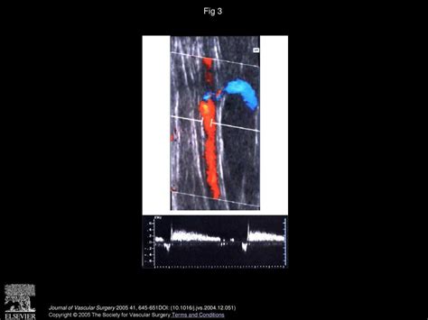 Patterns Of Saphenous Reflux In Women With Primary Varicose Veins Ppt