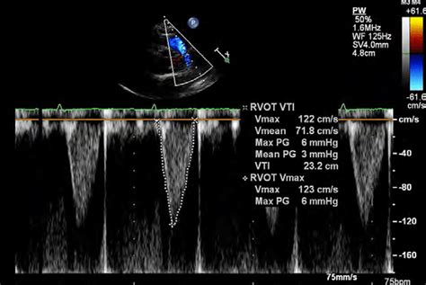 Transthoracic Echocardiograms Show A Severe Preoperative Right