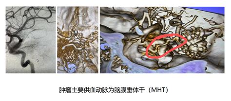 钙化型岩斜区脑膜瘤 脑医汇 神外资讯 神介资讯