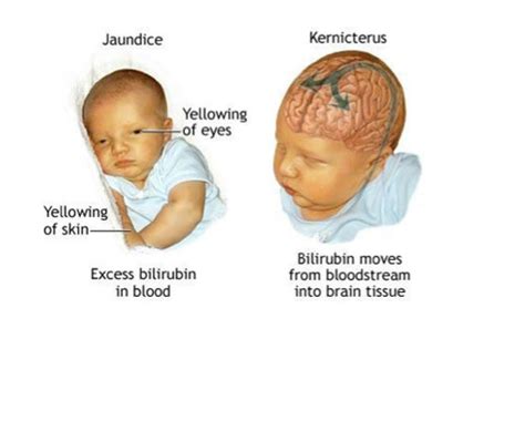 Hyperbilirubinemia Flashcards Quizlet