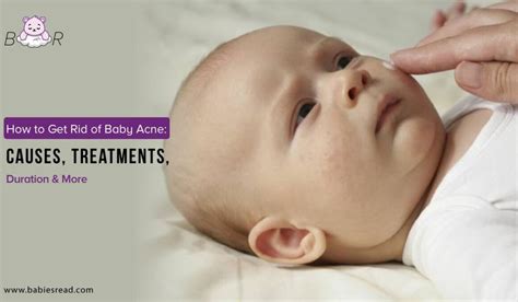 Baby Acne How To Get Rid Of It Treatment Insights More