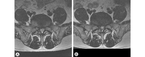 A Central Disc Herniation At L5 S1 B Cauda Equine Syndrome