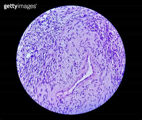 Photomicrograph Of A Schwannoma A Benign Soft Tissue Tumor Of