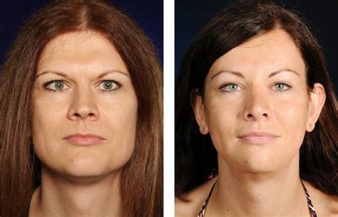 Before And After Facial Feminization Surgery Facial Feminization