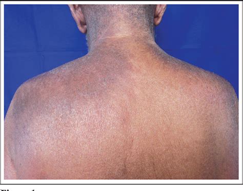 Figure 2 From Paraneoplastic Vesiculobullous Dermatomyositis With