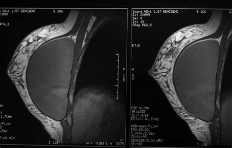 Breast Implant Flipped Or Rotated