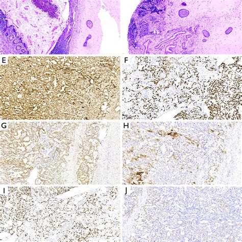 Histological Analysis Of The Bilateral Testicular Tumors And Download Scientific Diagram