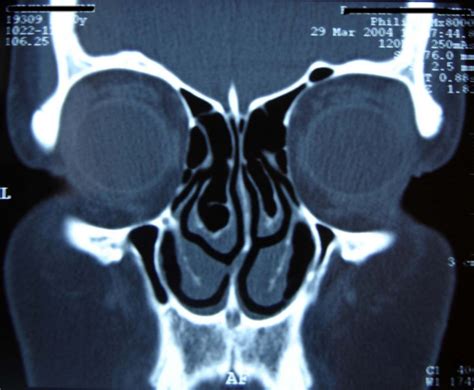 CT scan shows septal deviation and bilateral concha bullosa. | Download ...