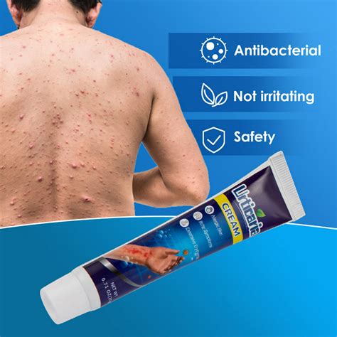 Crema Antiprurítica Para Urticaria, Pomada Antipicazón, Crema