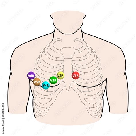 Right Sided Ecg Electrode Placement Electrocardiogram Lead V R V R