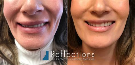 Uneven Smile Fixed With Botox Before After Photos New Jersey