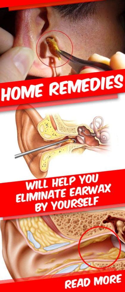 How To Eliminate Earwax At Home Health Hacks Health Advice Home