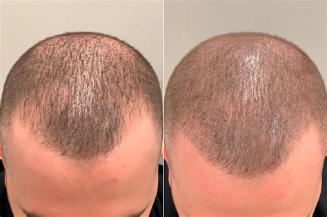 Scalp Micropigmentation Photos Miami FL Patient59740