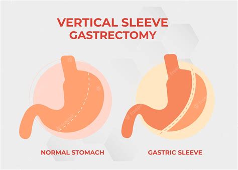 Premium Vector Laparoscopic Sleeve Gastrectomy Vertical Gastrectomy