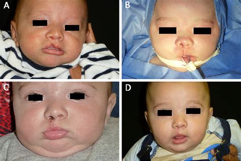 A Preoperative Appearance Of Incomplete Unilateral Cleft Lip B Download Scientific Diagram