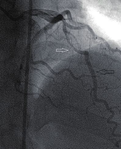 Images of myocardial bridge and LAD during systole on coro- nary ...