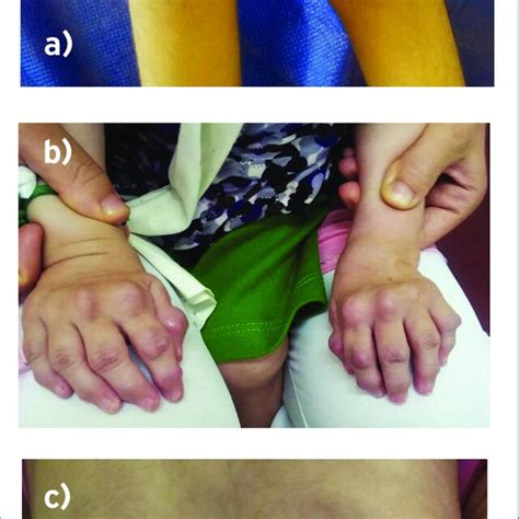 Multiple Nodules On Extensor Surface Of Hands In Case 3 At The Age Of Download Scientific