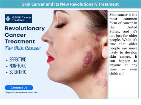 Ppt Skin Cancer And Its New Revolutionary Treatment Powerpoint