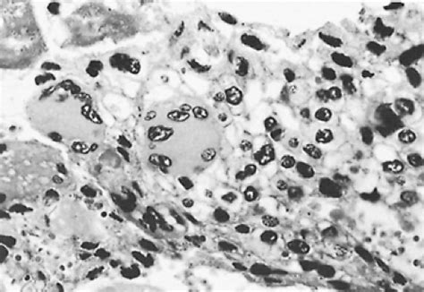 Nonseminomatous Malignant Germ Cell Tumors of the Mediastinum ...