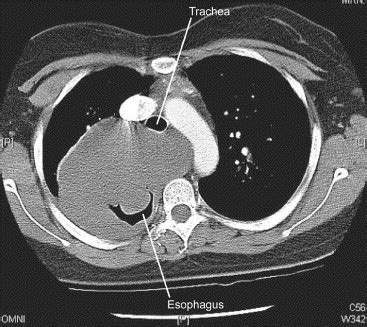 Mediastinal Tumors - Newport Cardiac & Thoracic Surgery