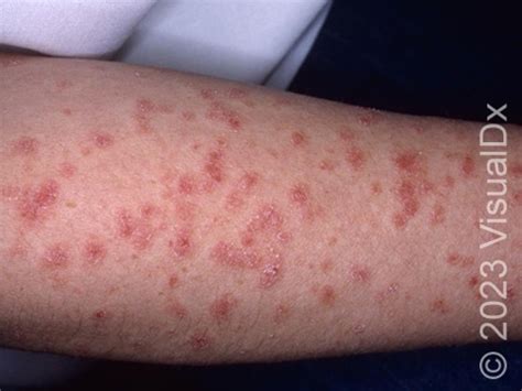 Guttate Psoriasis Condition Treatments And Pictures For Teens Skinsight