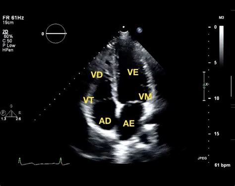 Apical View With The Four Chambers And Structures Identified Vd Right Download Scientific