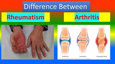 Difference Between Rheumatism And Arthritis Arthritis Rheumatism