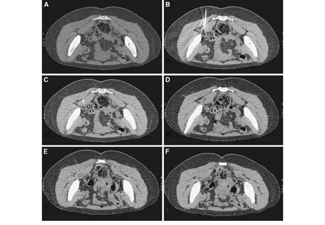 Ct Guided Injection Of Piriformis Muscle The Images Demonstrate