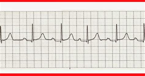 Ekg Practice Strips Printable - Customize and Print