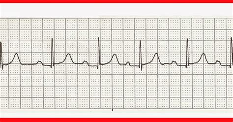 Ekg Practice Strips Printable With Answers