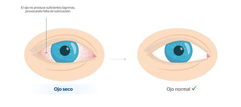 Ojos Rojos Causas Y Soluciones Blog De Cl Nica Baviera