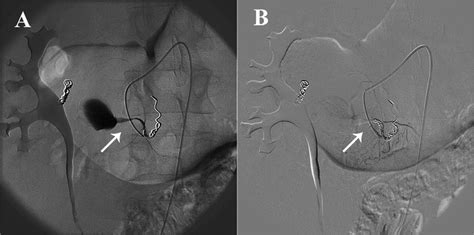 Super Selective Catheter Angiography Showing Collateral Vessels That Download Scientific