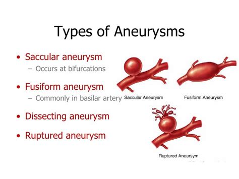 Brain Aneurysms And Av Malformations