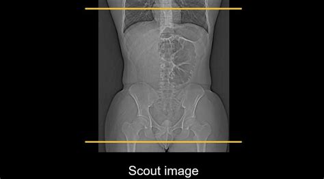 Abdominal CT Planes LITFL Radiology Library