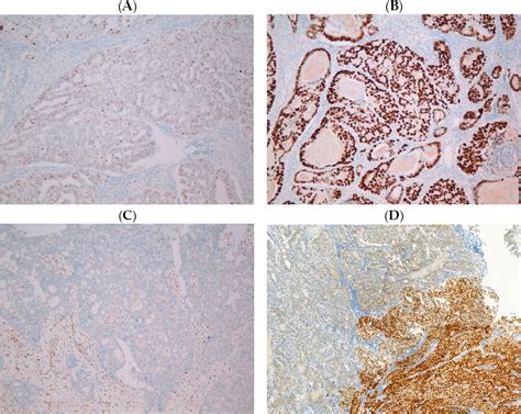 Figure 1 From Diagnostic Performance Of Immunohistochemistry Compared