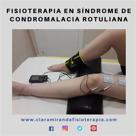 Fisioterapia Para El Tratamiento De La Condromalacia Rotuliana