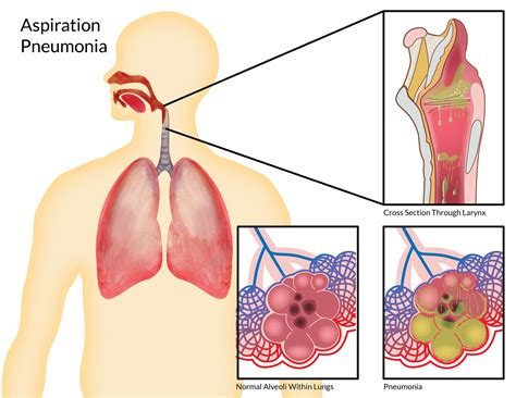 Aspiration pneumonia antibiotic treatment