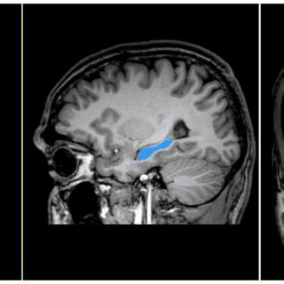 Cerebral MRI depicting manual segmentation of hippocampus. Figure shows ...